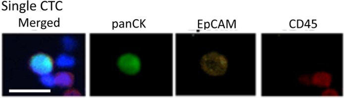 Detekcja pojedynczych komórek krążących izolowanych z krwi pacjentek za pomocą systemu CytoTrack. Barwienie: pan-cytokeratyny (panCK) – zielony, EpCAM – żółty, CD45 (komórki układu immunologicznego) – czerwony.